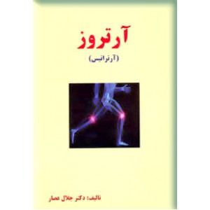 آرتروز